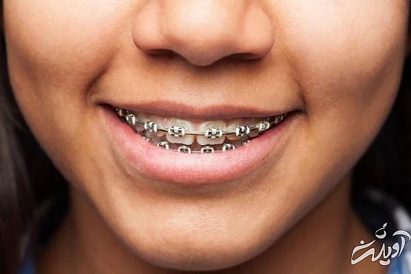 عوارض ارتودنسی